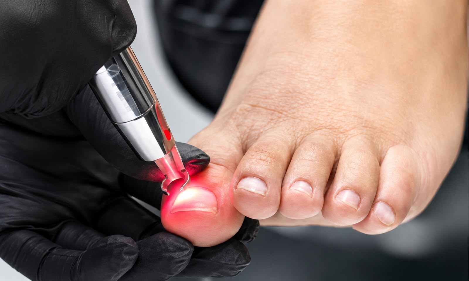 Láser Onicomicosis en PURAVÉ, Belén